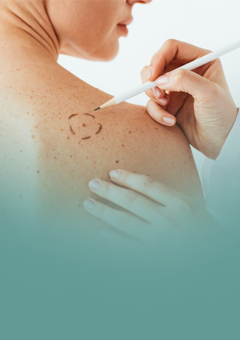 Biópsia de Lesões Cutâneas Suspeitas